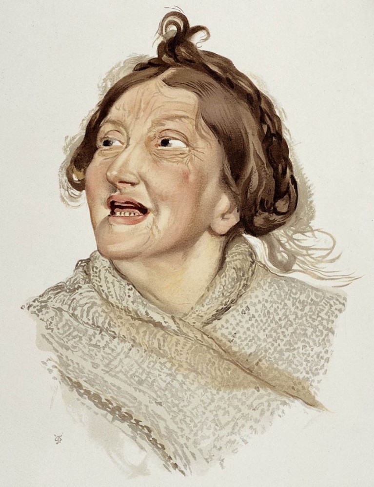 J. Williamson, Femme atteinte de manie hilarante.
Credit: Wellcome Library, London. Wellcome Images
images@wellcome.ac.uk
http://wellcomeimages.org. Creative Commons Attribution only licence CC BY 4.0 http://creativecommons.org/licenses/by/4.0/